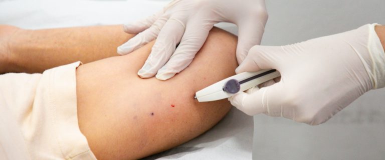 PERUÍBE REALIZA MUTIRÃO DE IMPLANON